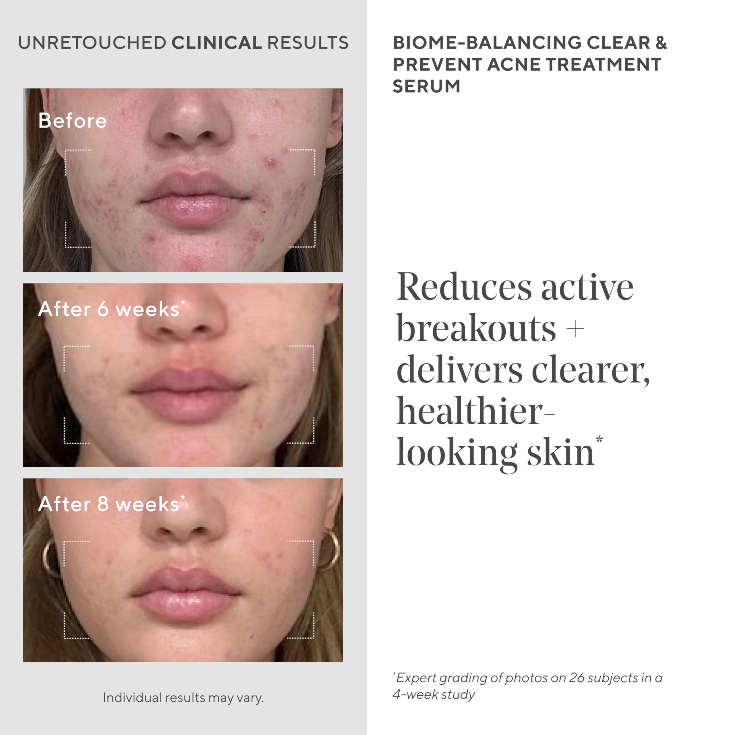 Acne Treatment Trial Kit – Salicylic Acid & Mandelic Acid for Clear Skin – Oil Control, Spot Treatment & Cleanser – Travel Size Skincare for Acne-Prone Skin (3-Piece Clear Skin Kit) - Image 5