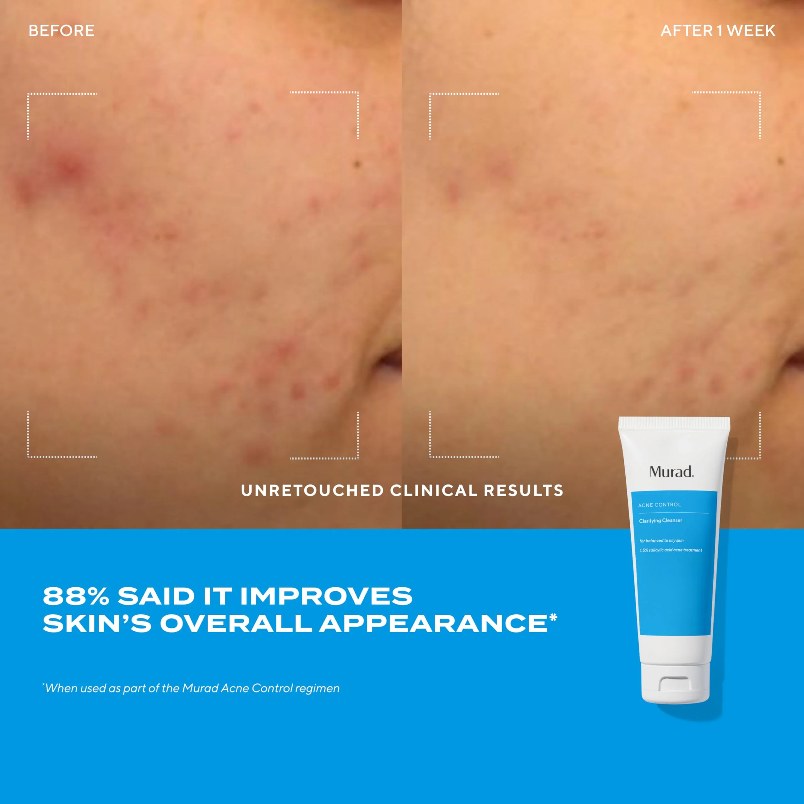 Acne Treatment Trial Kit – Salicylic Acid & Mandelic Acid for Clear Skin – Oil Control, Spot Treatment & Cleanser – Travel Size Skincare for Acne-Prone Skin (3-Piece Clear Skin Kit) - Image 7