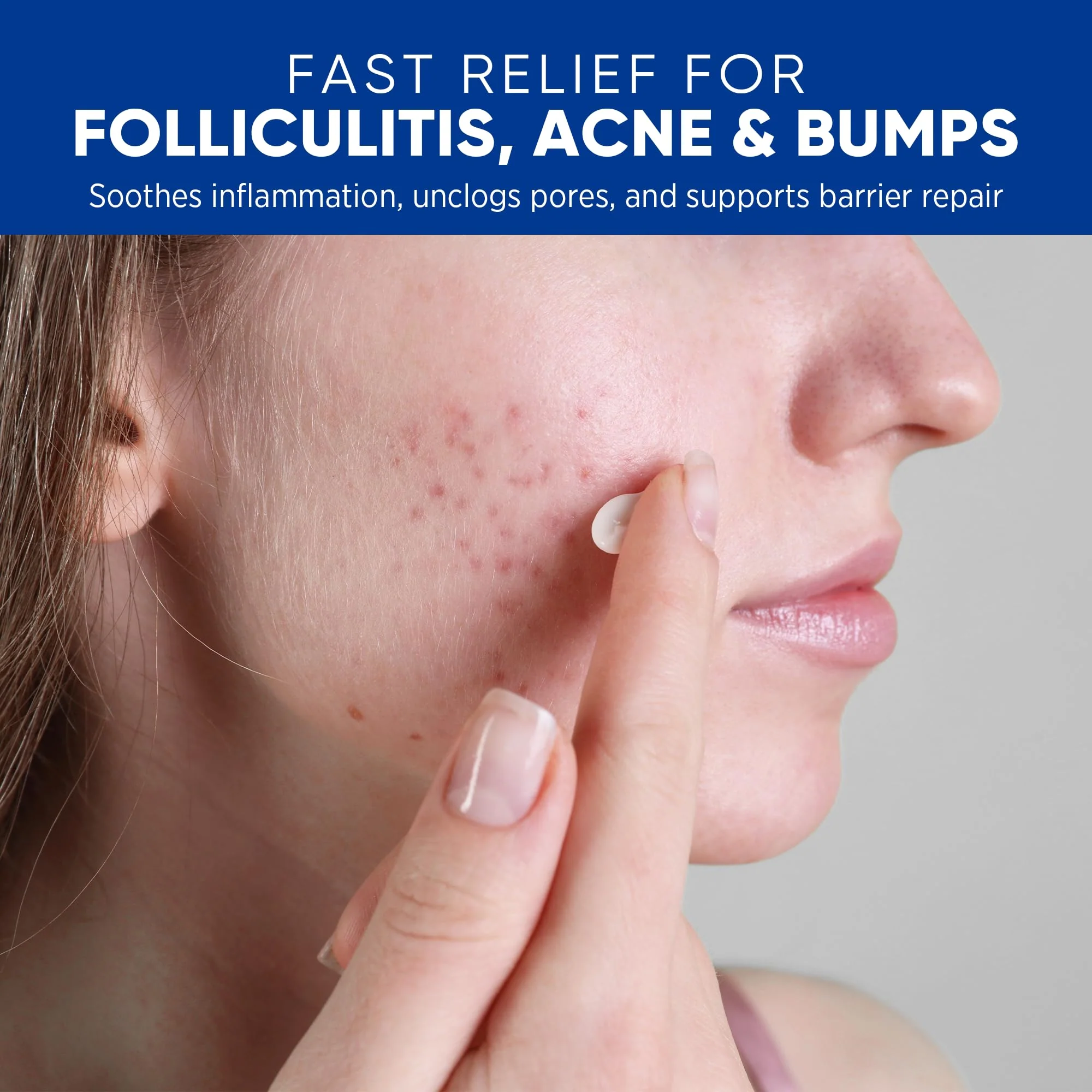 AOSORW Folliculitis & Acne Treatment Cream – Salicylic Acid & Herbal Extracts for Scalp, Face, Body & Back – Soothes Irritated Skin, Redness & Itch Relief – 100g (Pack of 1) - Image 9
