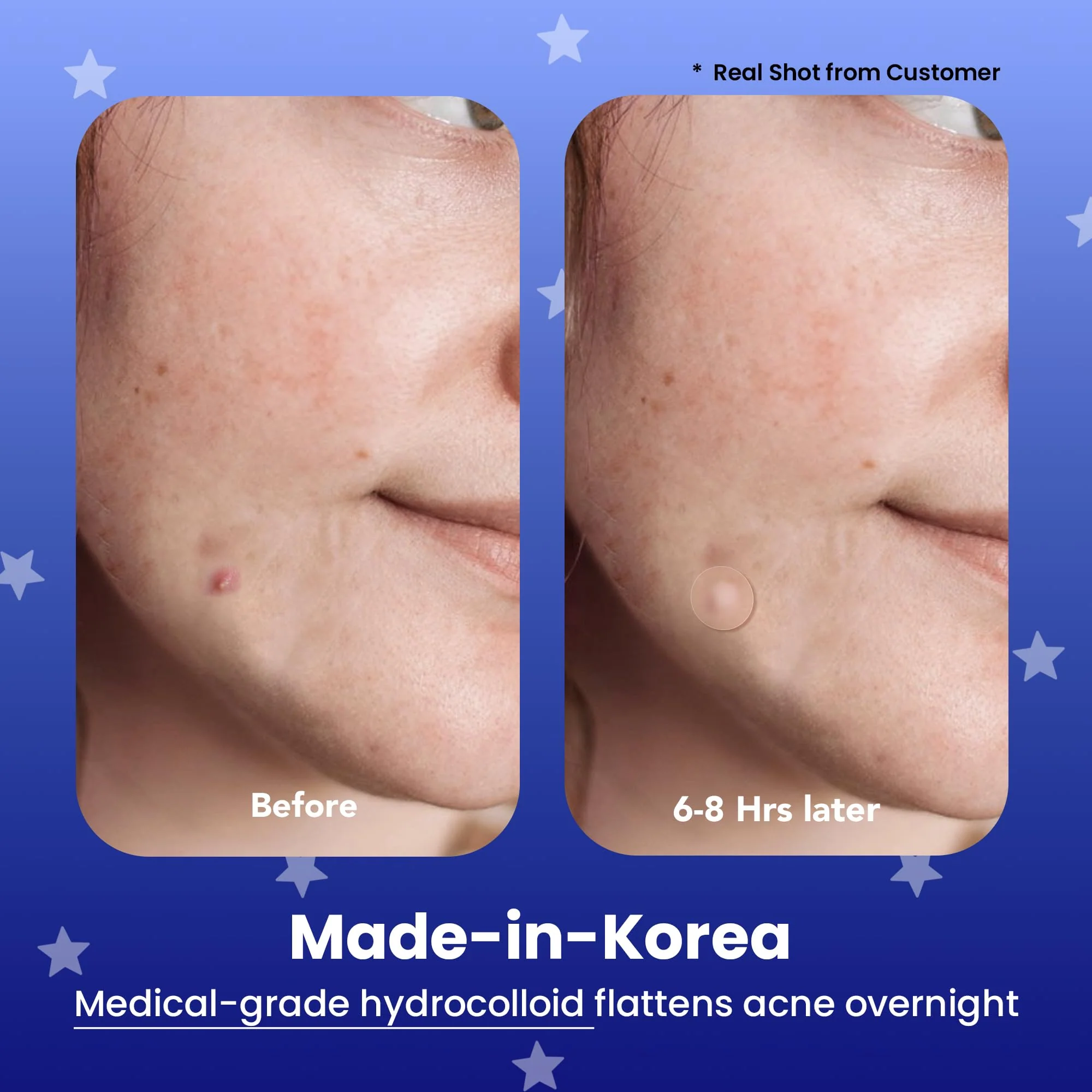 AVARELLE Spot Pimple Patches for Face | Good Night Acne Cover | Hydrocolloid with Tea Tree Oil | Acne Spot Treatment (12-14 mm, 96 ct) - Image 7
