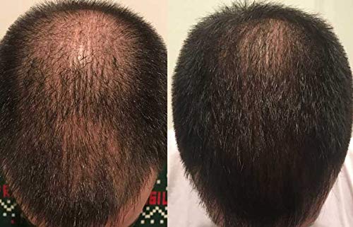 Zenagen Revolve Thickening Hair Loss Treatment for Men - Image 4