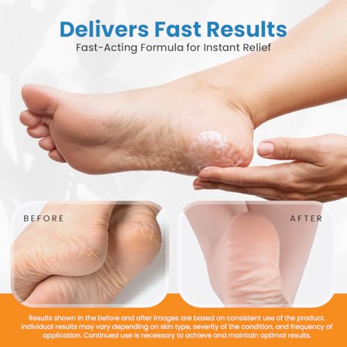 Revitaderm 4D Urea Cream 40 Percent for Feet Maximum Strength, for Dry Hands, Elbows and Knees, Callus Remover for Feet, Free Pumice Stone, 4oz, 1 Pack - Image 4