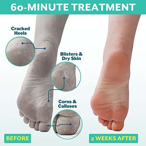 Patchology PoshPeel Pedi Cure - Foot Peel Mask Soak Treatment, Pedicure Foot Spa, Feet Peeling Mask, Pedicure Booties w/Deep Exfoliation for Baby-soft Skin, Pedicure Supplies for Foot Care, 1 Pair - Image 2