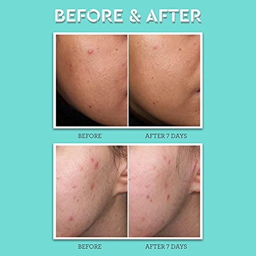Bliss Clear Genius Acne Spot Treatment – Maximum Strength 2% Salicylic Acid Shrinks Blemishes – Clean, Vegan, Cruelty-Free, 0.5 Fl Oz - Image 4