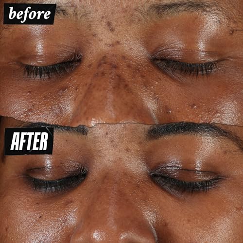 Kiehl's Clearly Corrective Dark Spot Serum, Brightening Facial Serum, Reduces Hyperpigmentation & Post-acne Marks, with Vitamin C & Salicylic Acid, All Skin Types, Paraben-free, Mineral Oil-free - Image 3