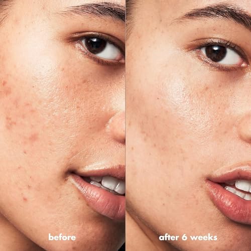e.l.f. SKIN Blemish Breakthrough Blemish Control Basics Kit, Travel-Size Acne Skincare Routine, Cleanser, Serum & Moisturizer, Vegan & Cruelty-Free - Image 4