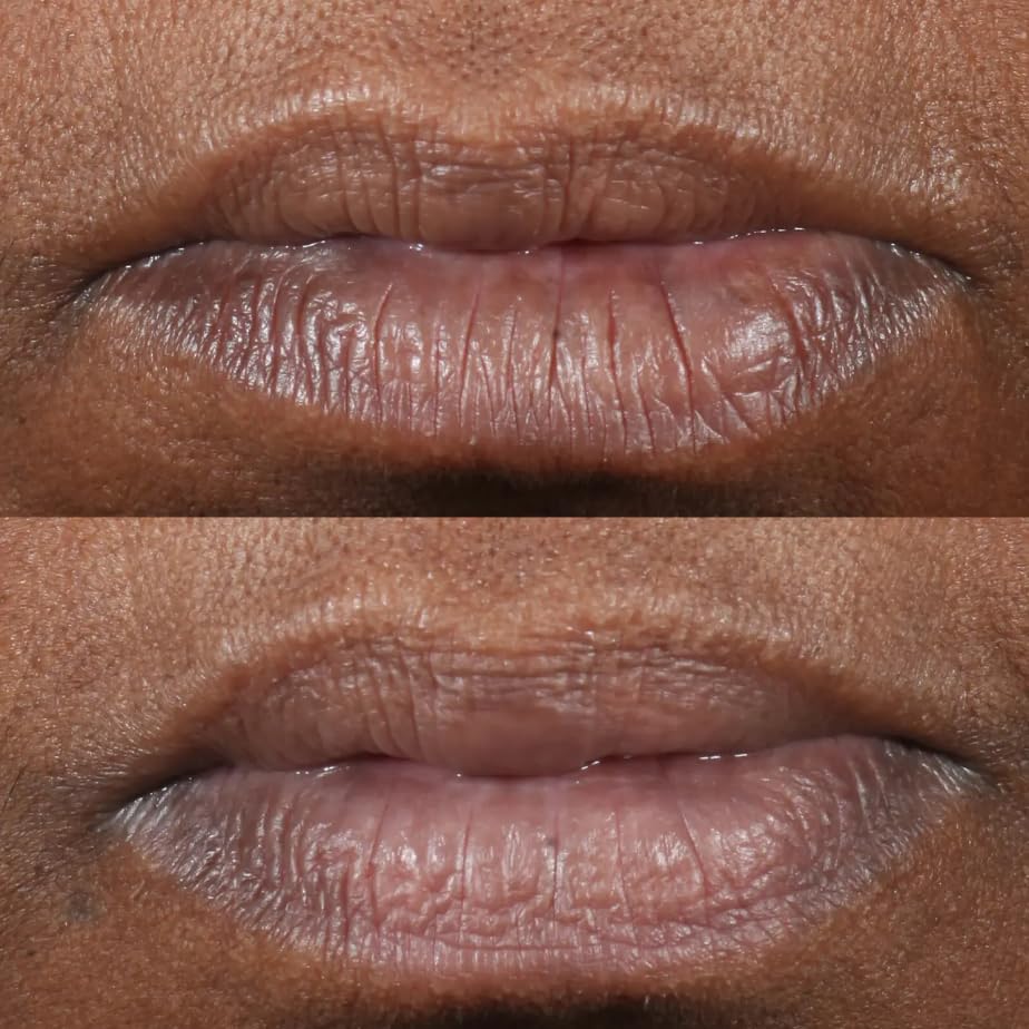 Cold Plasma Plus+ Lip Therapy - Image 4