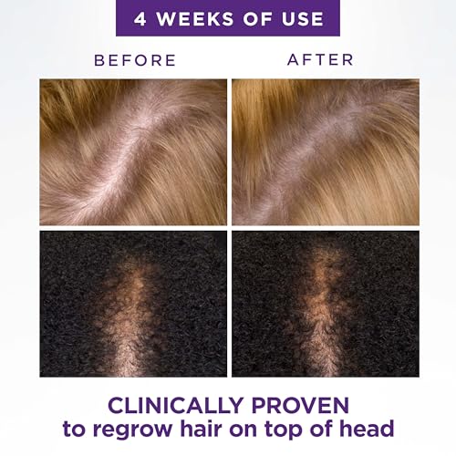 Head & Shoulders Scalp X 2% Minoxidil for Women, Hair Regrowth Treatment for Thinning Hair and Hair Loss, Topical Solution, 3 Month Supply, 2 Fl Oz Each, Pack of 3 - Image 6