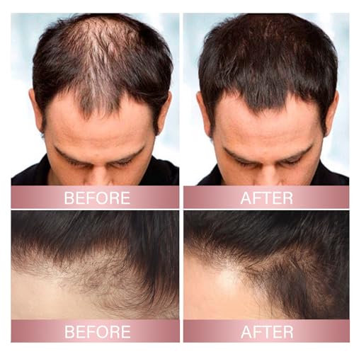 H-Regrow 2.0 - Hair Regrowth Spray with Biotin, Caffeine, Rice, Ginger, Castor Oil - 1PCS - Image 4