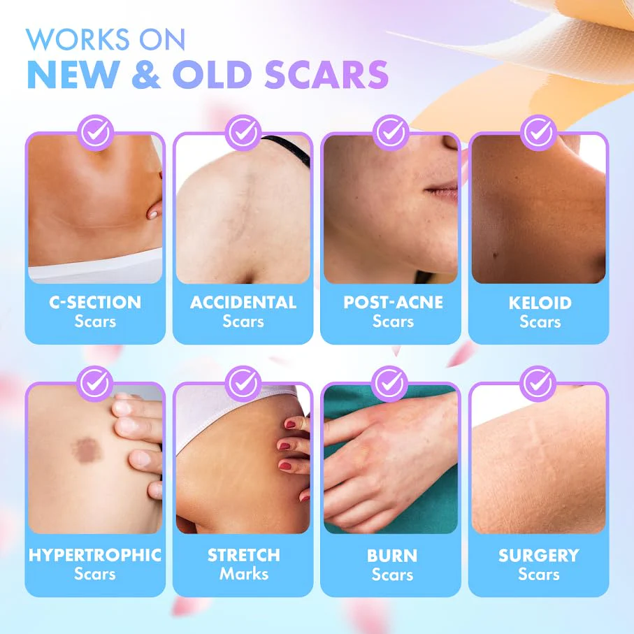 Silicone Scar Tape for Surgical Scars, Keloid, C-Section and More - Silicone Scar Sheets 130 x 1.5 inch - Effective Scar Treatment and Scar Removal for Face and Body - Silicone Tape for Scars - Image 4