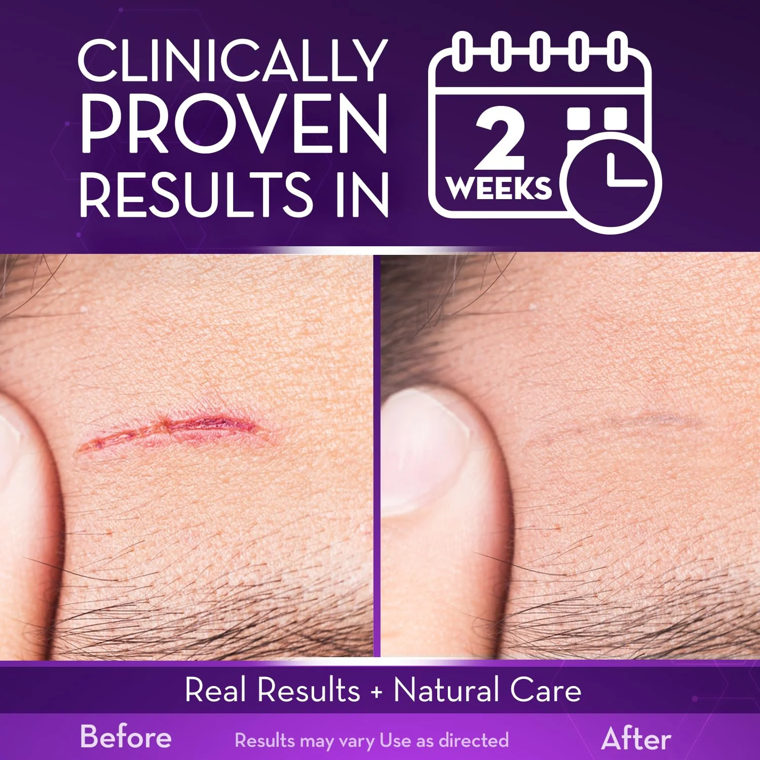 Cicatricure Advanced Scar Gel for Face & Body - Proven Results in 2 Weeks, Scar Treatment for Surgical Scars, Stretch Marks, Scars of Burns and Injuries, Acne Scar Treatment, 1 oz (28 g) - Pack of 3 - Image 3