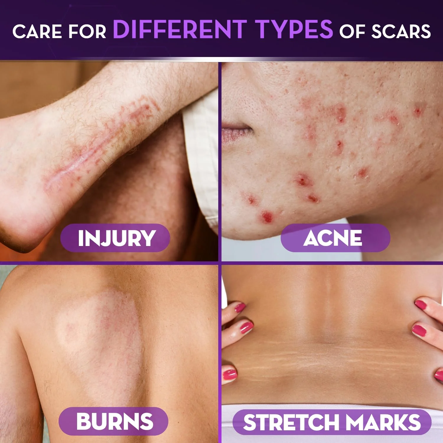 Cicatricure Advanced Scar Gel for Face & Body - Proven Results in 2 Weeks, Scar Treatment for Surgical Scars, Stretch Marks, Scars of Burns and Injuries, Acne Scar Treatment, 1 oz (28 g) - Pack of 3 - Image 4
