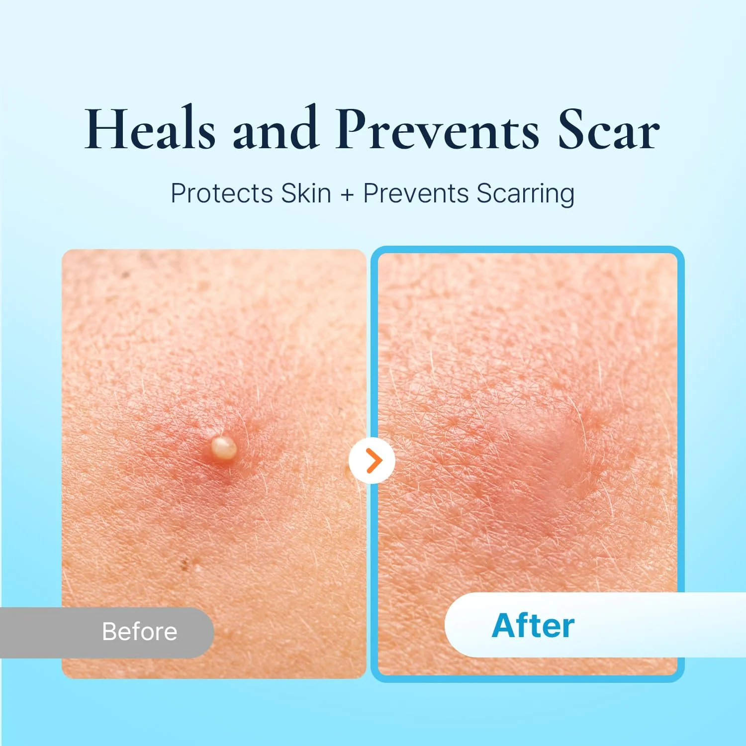 DERMAKR Discreet Acne Pimple Patch | Spot Cover & Treatment Solution Cystic Acne & Pimple | Hydrocolloid Facial Stickers | Waterproof Patches Invisibly Cover Pimples (4packs) - Image 6