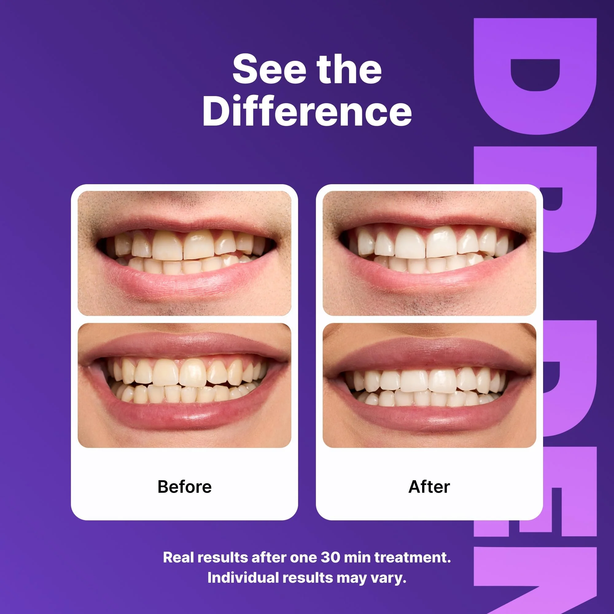 DrDent Professional Teeth Whitening Strips 21 Treatments - Safe for Enamel - Non Sensitive Teeth Whitening - Whitening Without Any Harm - Pack of 42 Strips + Mouth Opener Included - Image 3
