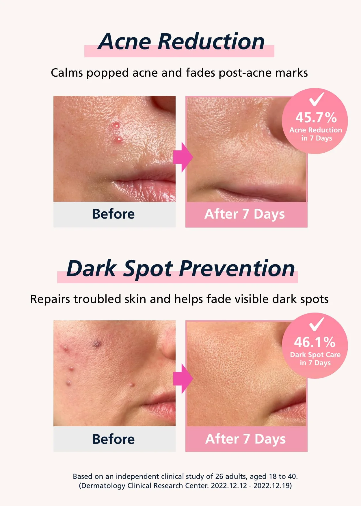 Easyderm Real Calming Patch Microdart Pimple Patches, Clear Nano Micropoint | Niacinamide, Hyaluronic Acid, EGF Acne Dark Spot Care, K-beauty | 12 Counts - Image 7
