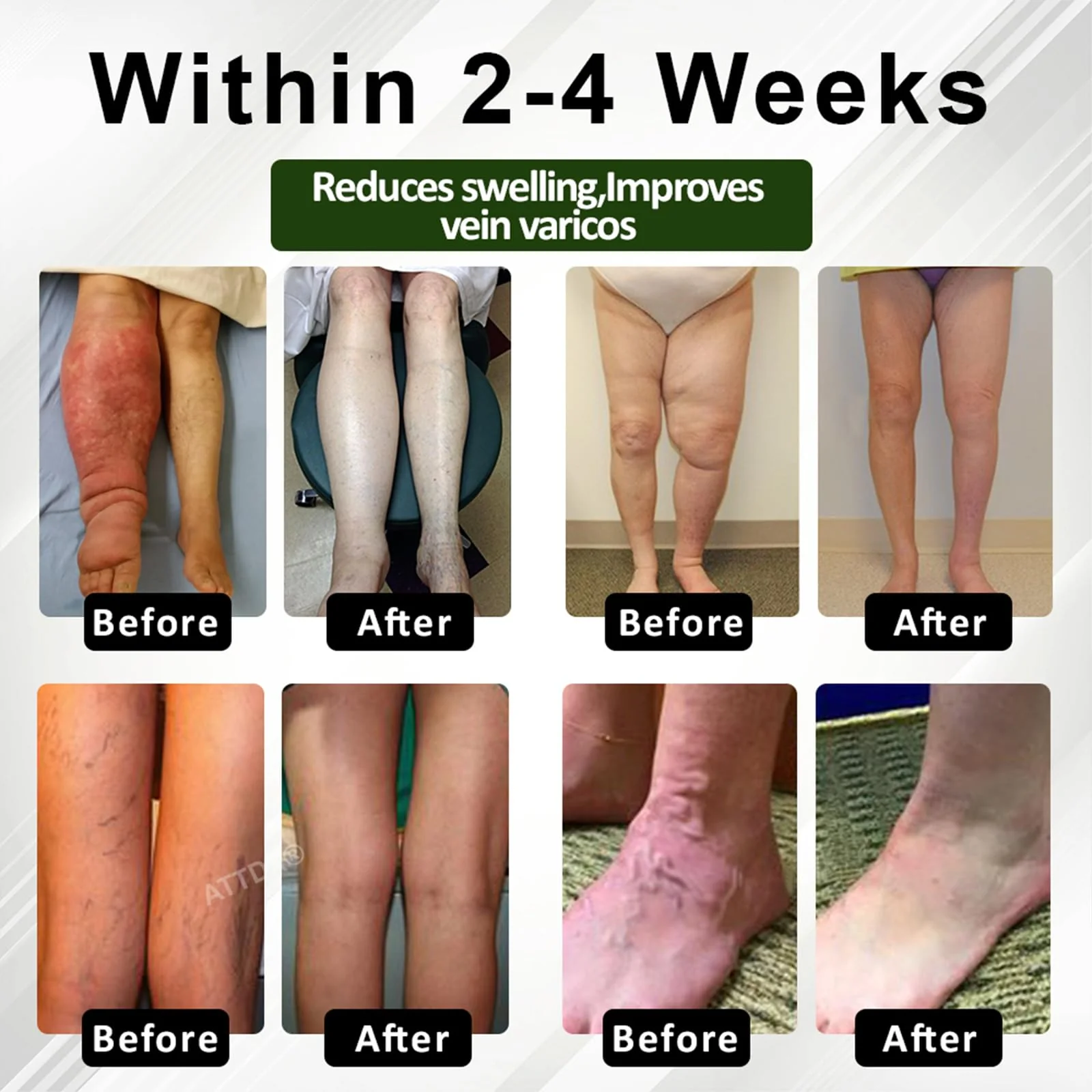Fluidease Leg Therapy Edema Cream, Fluid Ease Leg Therapy Cream, Lymphatic Drainage Massage Cream, Swell Care Lymphatic Massage Cream, Edema Relief for Legs and Feet (1) - Image 3