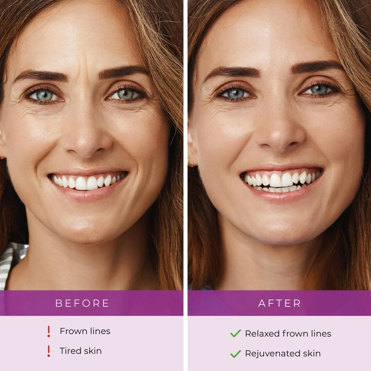 Furlesse Elevens Wrinkle Patches, Relax Fine Lines, Non-Invasive Anti-Wrinkle Tape for Frown Lines, Anti-Aging Skincare, 30-Count, 30-Day Use - Image 8