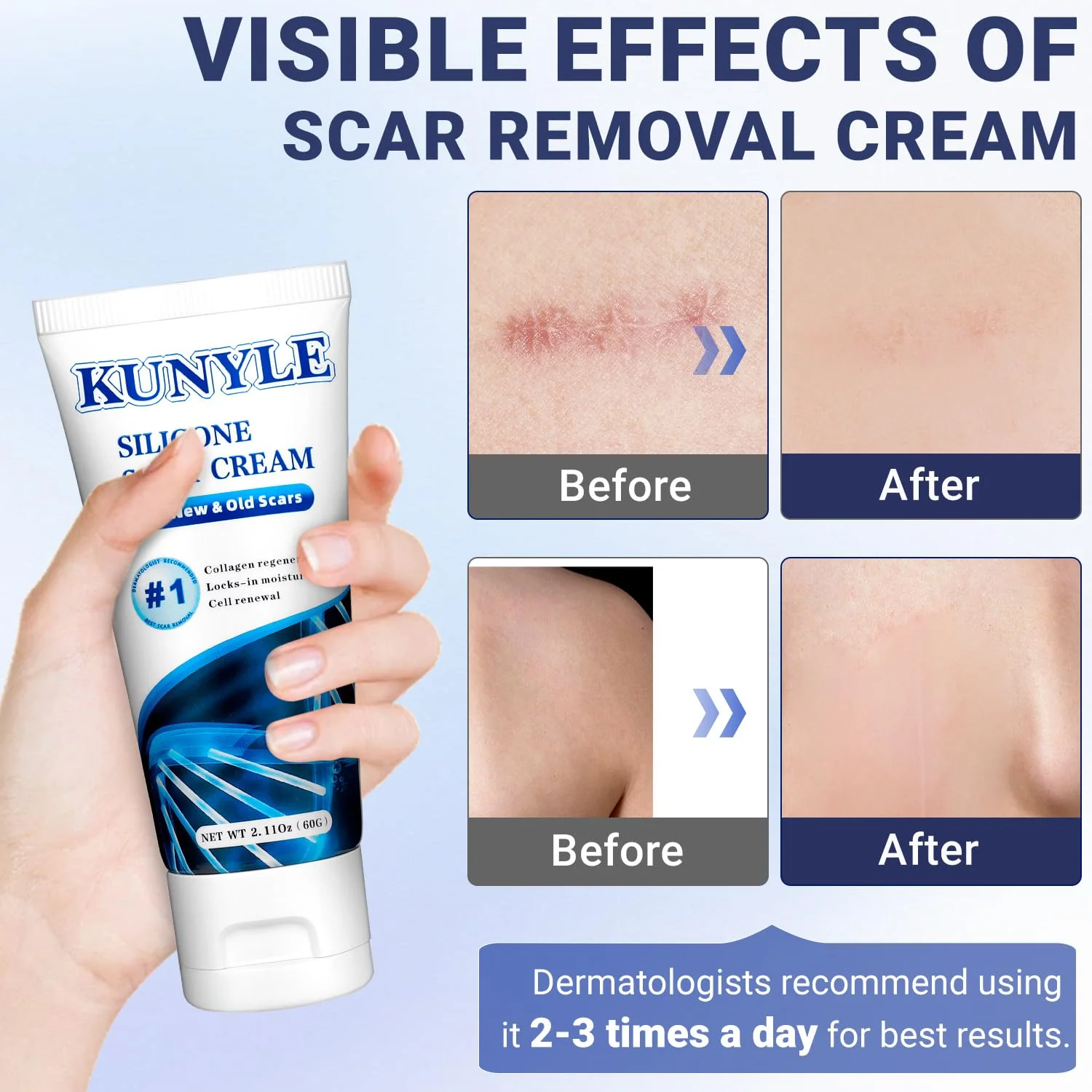 Kunyle Scar Cream, Silicone Scar Gel, Advanced Scar Removal Cream for Surgical Scars, Stretch Marks Removal, Keloid Bump Removal, Old and New Scars 2.11 Oz (60g) - Image 8