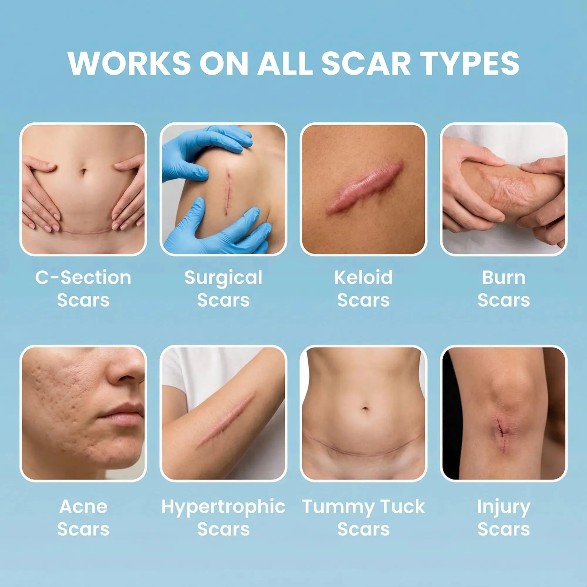 Medical Grade Silicone Scar Tape 1.6" x 120" – Reusable Sheets Roll for C Section, Keloid, Tummy Tuck & Surgical Scar Removal – Burn Scar Treatment Strips - Image 9