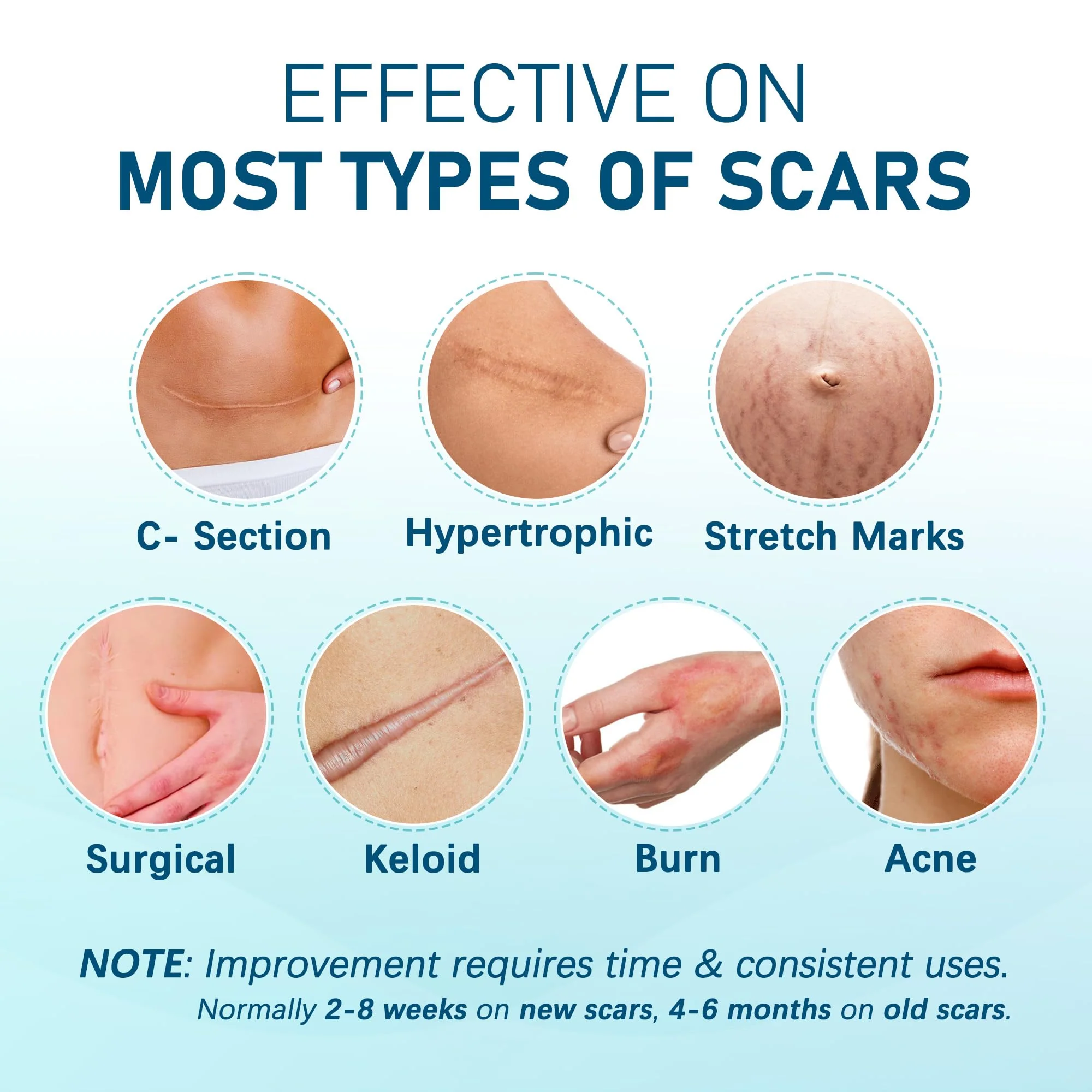 MEDLOT Silicone Scar Sheets, Large 10Pcs 4” x 7” Each, Medical Silicone Tape for Scar Treatment, Scar Patches for C-Section, Keloid Bump, Stretch Marks, Burn, Acne, Surgical Scar Removal - Image 6