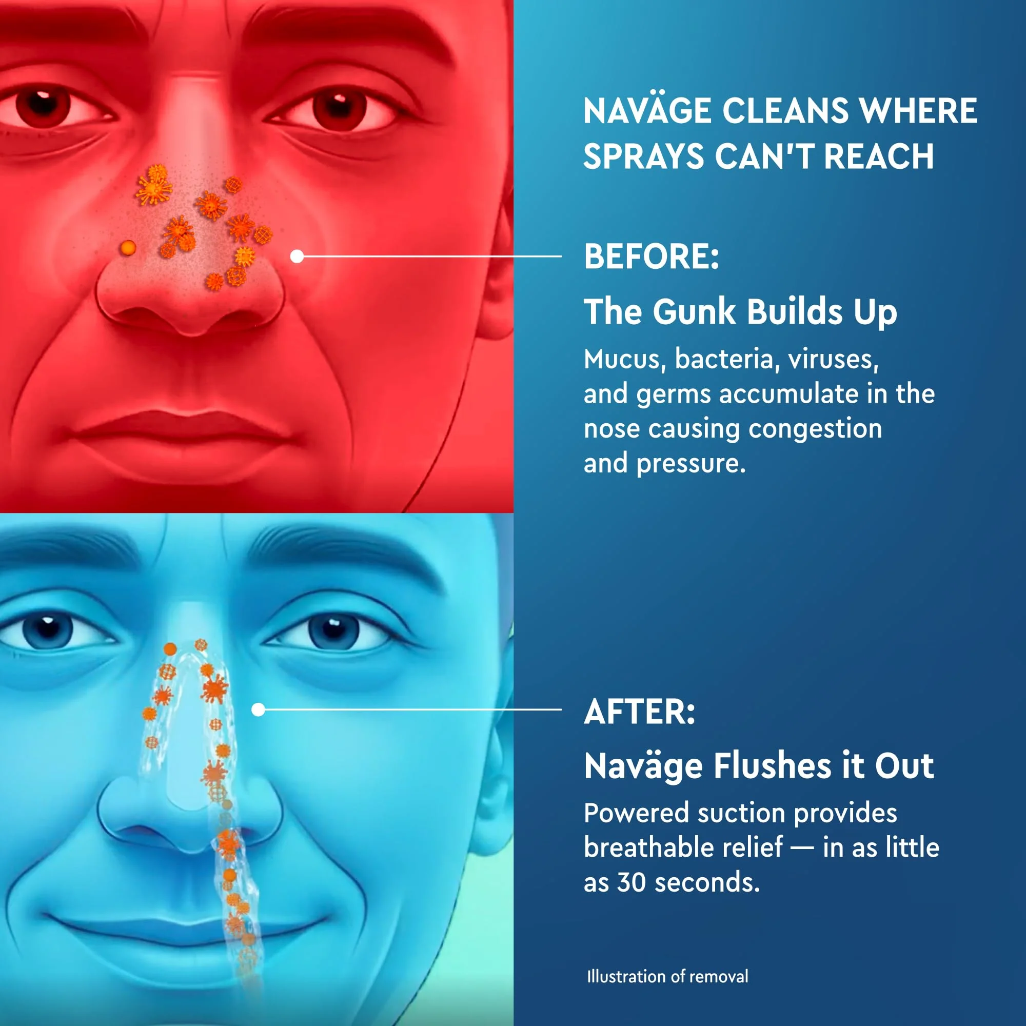 Navage® Nasal Irrigation System Deluxe Bundle, Nose Cleaner for Congestion Relief w/ 30 SaltPods, Storage Caddy, Black Travel Bag & Batteries ($137 Value). Sinus Rinse for Clinically Proven Benefits - Image 8