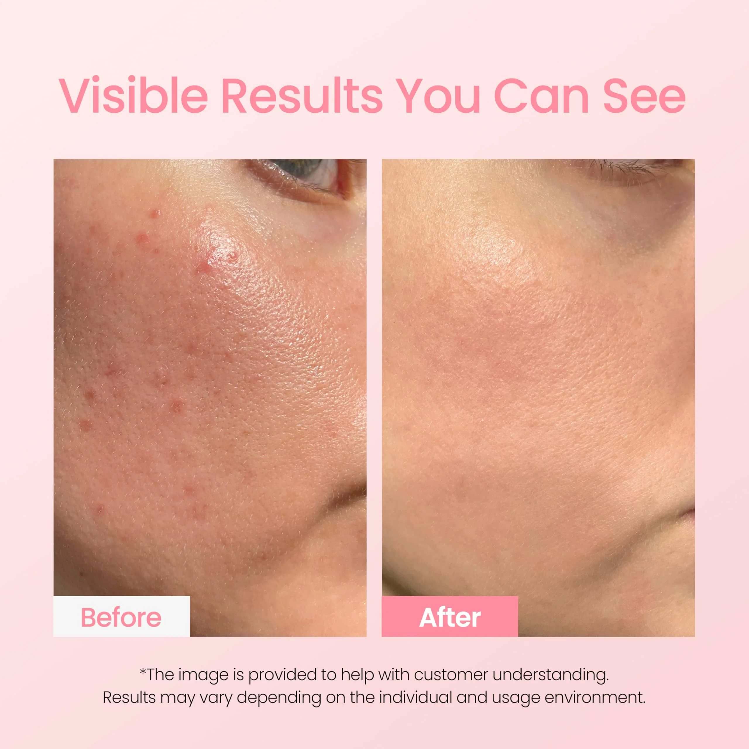 NEOGEN A-Clear Soothing Pink Eraser, Spot Care, Blemish Care, Korean Skin Care, Pink Pimple Drying Power, Calamine Powder, Nighttime Spot for Face and Skin (0.50 Fl Oz) - Image 3
