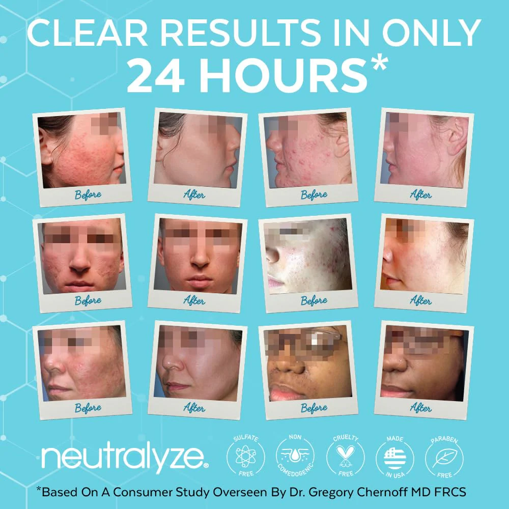 Neutralyze Moderate to Severe Acne Treatment Kit 2.0 - Maximum Strength 3 Step Acne Kit with 2% Salicylic Acid, 2% Mandelic Acid & Nitric Oxide - Includes Face Wash, Clearing Serum & Synergyzer - Image 4