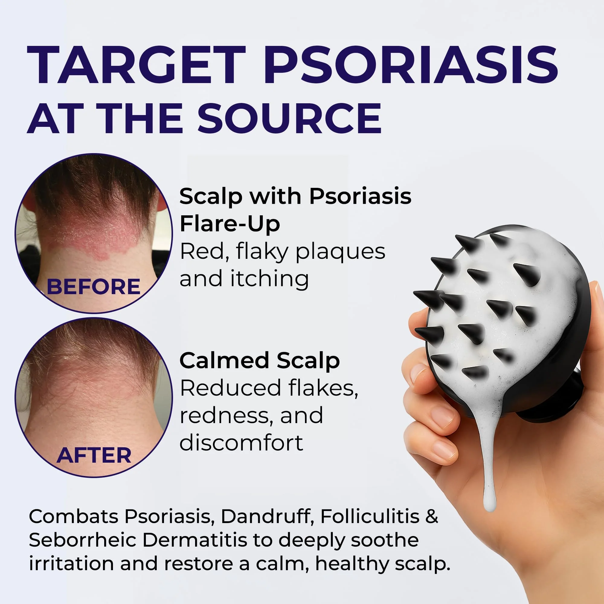 Psoriasis Shampoo Anti Dandruff - Medicated shampoo for Dandruff, Flakes, Seborrheic Dermatitis & Folliculitis Treatment - Anti Fungal Solution for Itchy, Flaky & Dry Scalp - 200ml - Image 6