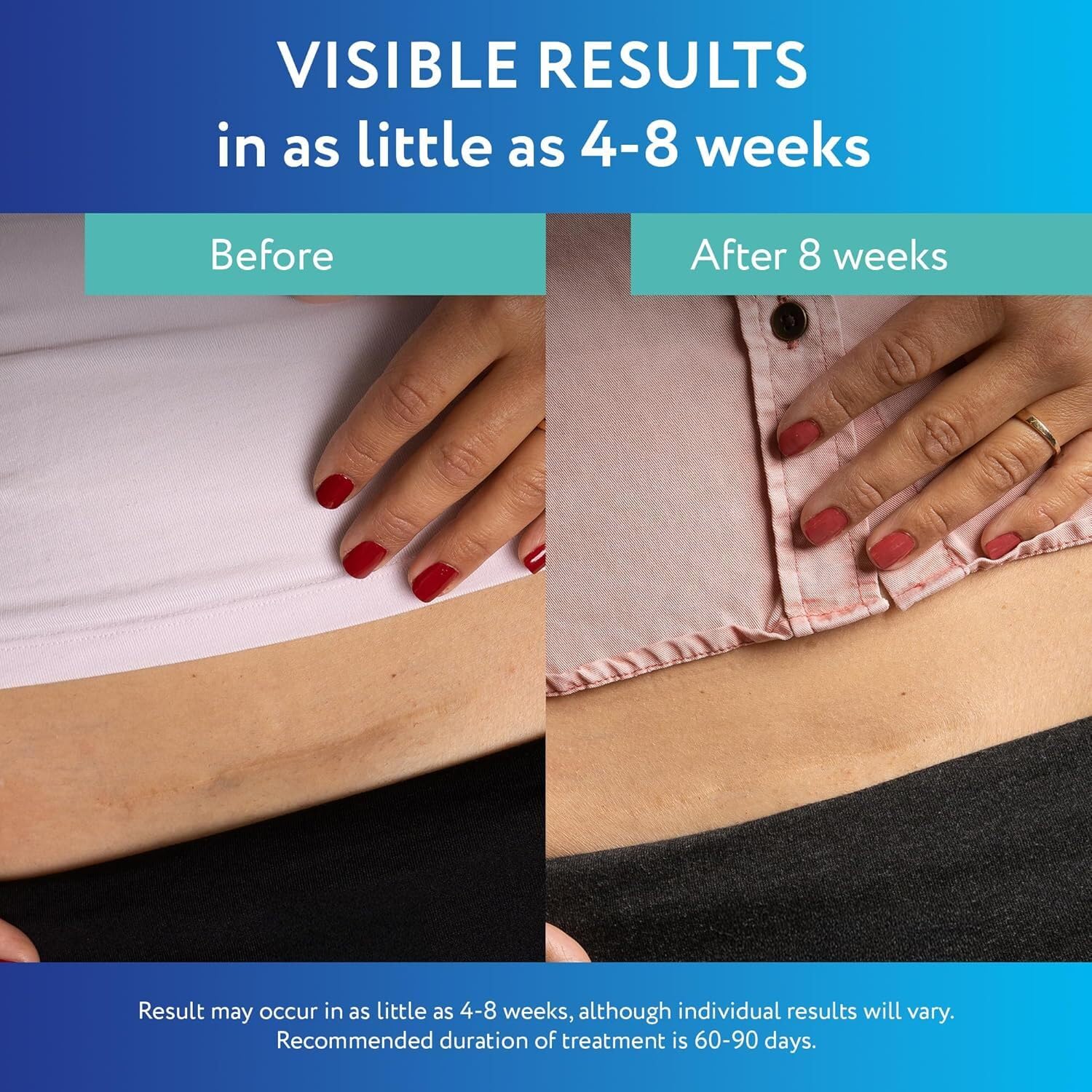 ScarAway Advanced Clear Silicone Scar Sheets, Medical Grade Silicone Strips (1.5" x 3") Scar Treatment and Prevention for Surgical, Burn, Body, Hypertrophic & Keloid Scar Treatment, 6 Clear Sheets - Image 4