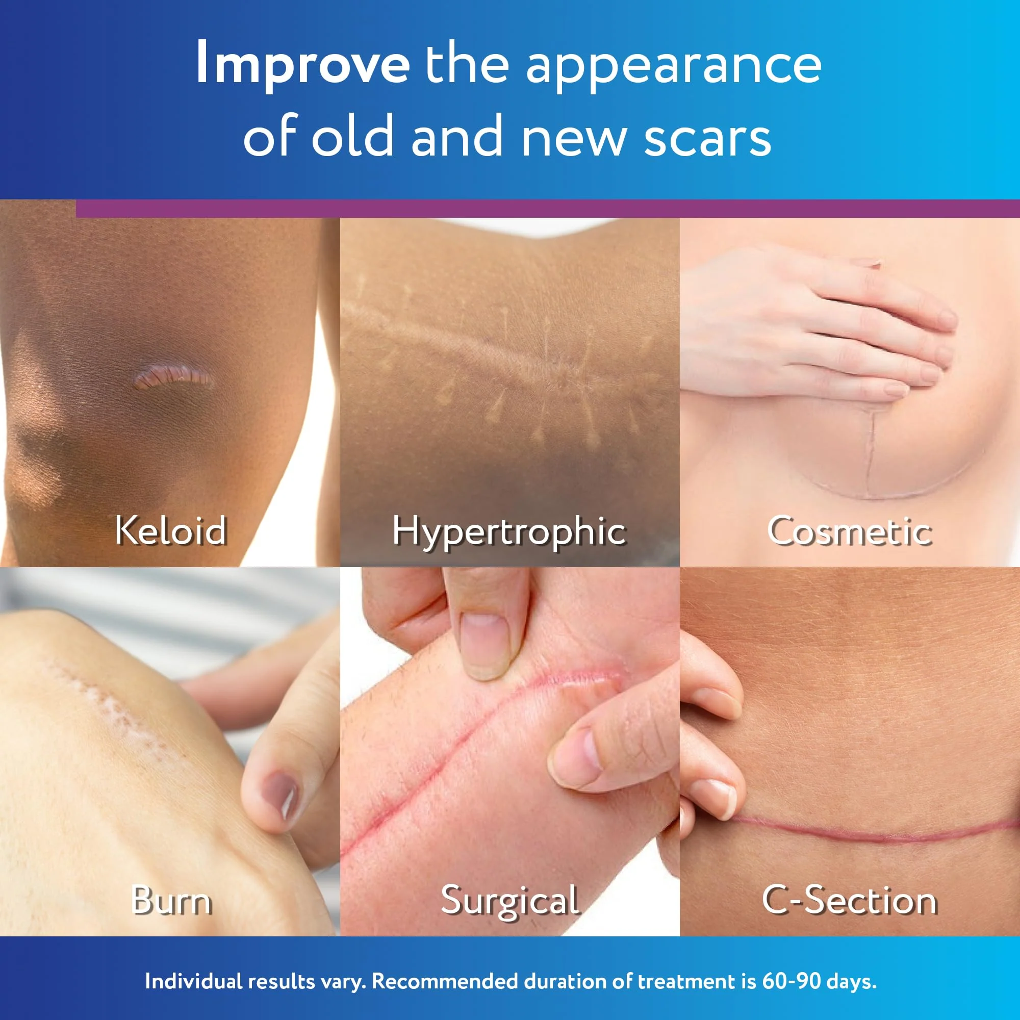 ScarAway Silicone Scar Gel, Helps Improve Size, Color & Texture of Hypertrophic & Keloid Scars from Injury, Burns & Surgery, Water Resistant, 10g (0.35 Oz) - Image 3