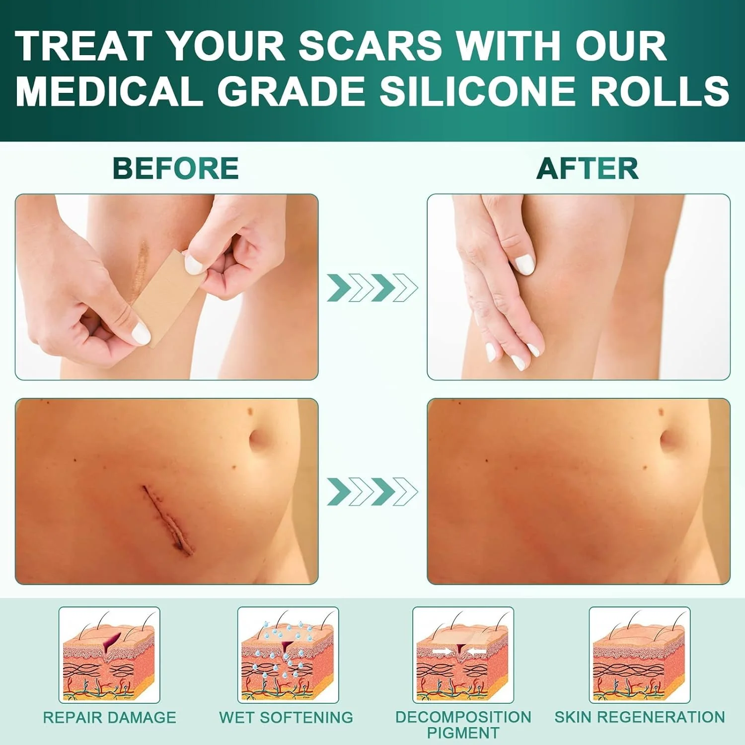 Silicone Scar Sheets,Silicone Scar Tape(1.6"x 120" Roll-3M), Reusable and Effective Scar Removal Sheets, Silicone Scar Removal Sheets for Surgical Scars,Healing Keloid, C-Section, Tummy Tuck - Image 7