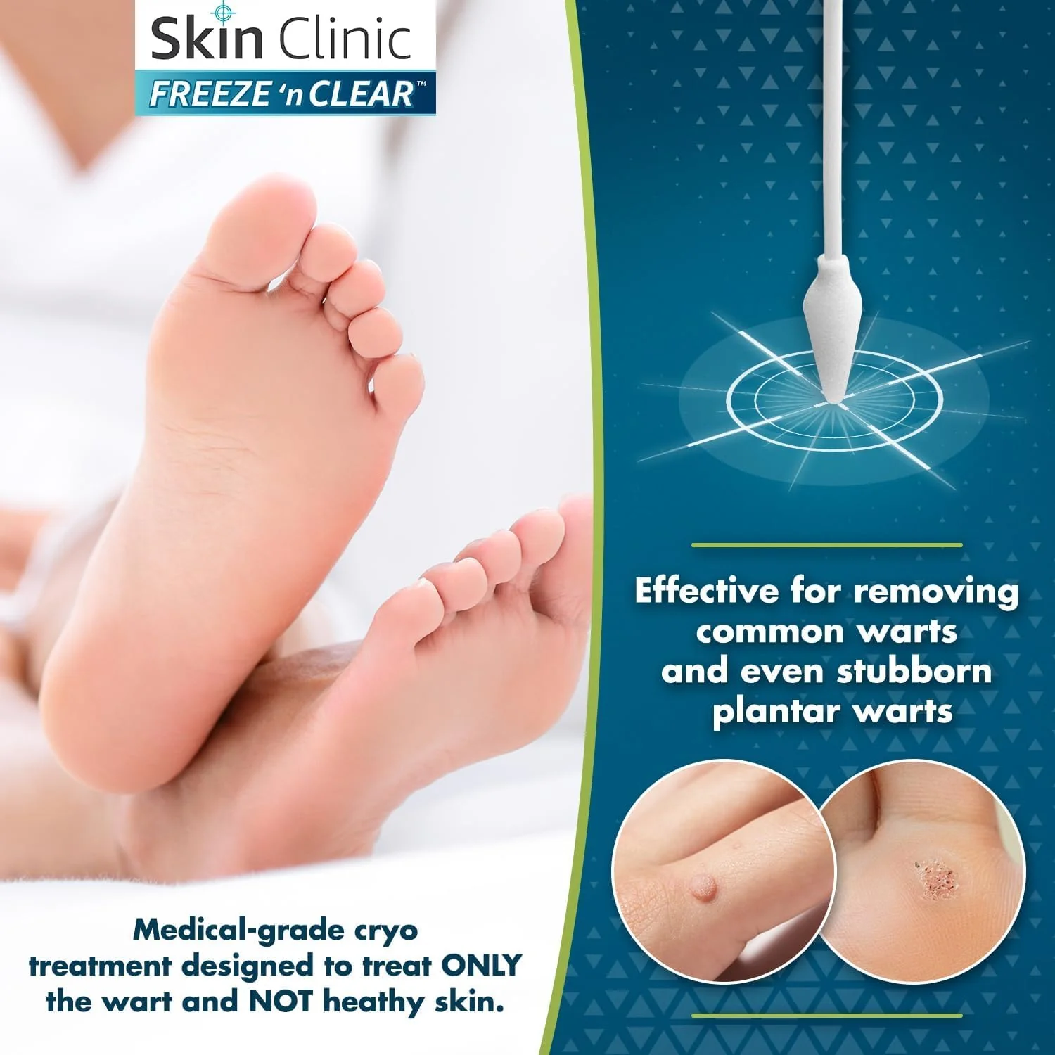 Skin Clinic Freeze 'n Clear Advanced Wart Remover - USA Made Cryo-Freeze Kit with 12 Precision-Tip Applicators - FDA-Cleared Freezing Wart Treatment Solution for Adults & Kids 4+ - Image 5