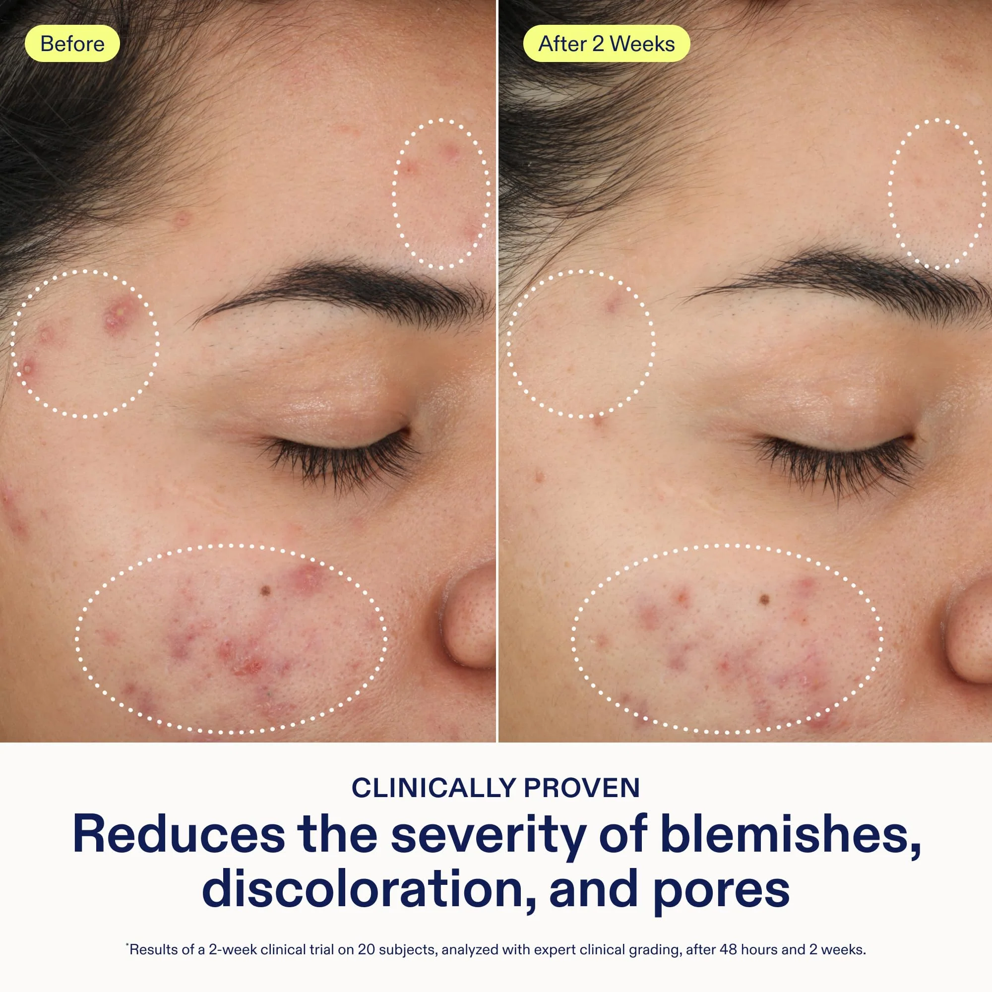Skinfix 2% BHA Cleanser - 5 oz - Clears Acne Blemishes & Blackheads - Safe for All Types of Acne - Fragrance Free - Vegan, Cruelty Free - Image 7