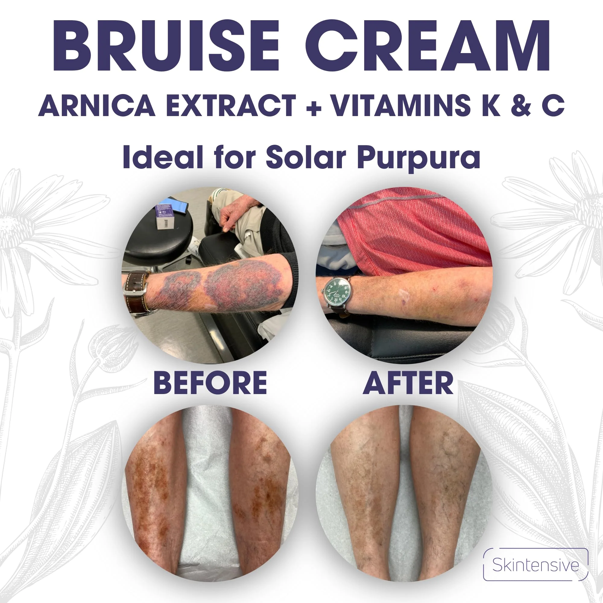 SKINTENSIVE Arnica Bruise Cream for Thin Skin - Moisturizing Arnica Cream, Vitamin K C and E, Skin Renewal, 4 Oz - Image 6