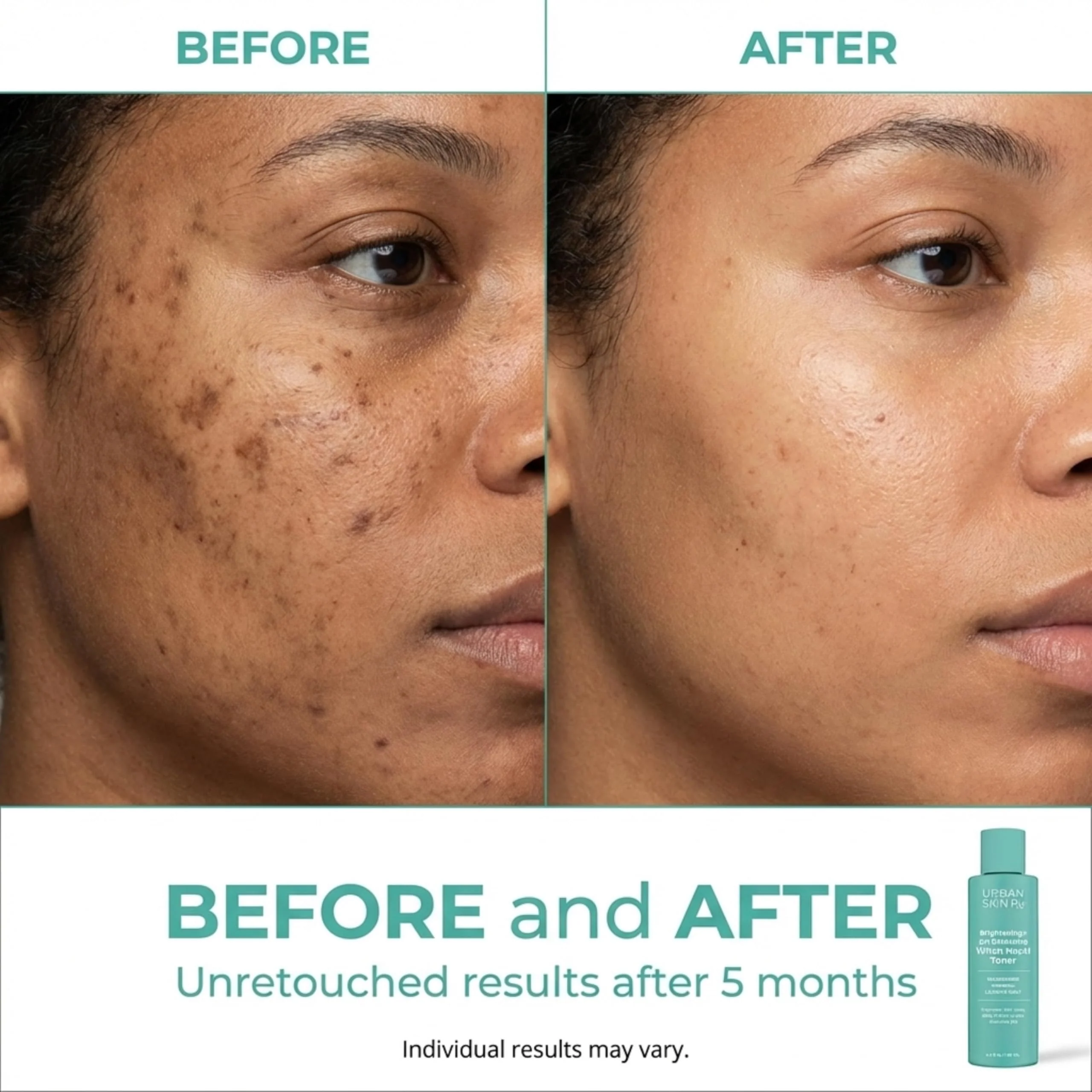 Urban Skin Rx® Witch Hazel Brightening & pH Balancing Toner, Exfoliated & Clarifies Clogged Pores, Improves The Appearance of Uneven Skin Tone, Reduces Redness & Brightens Dull Complexions, 4.5 Fl Oz - Image 5