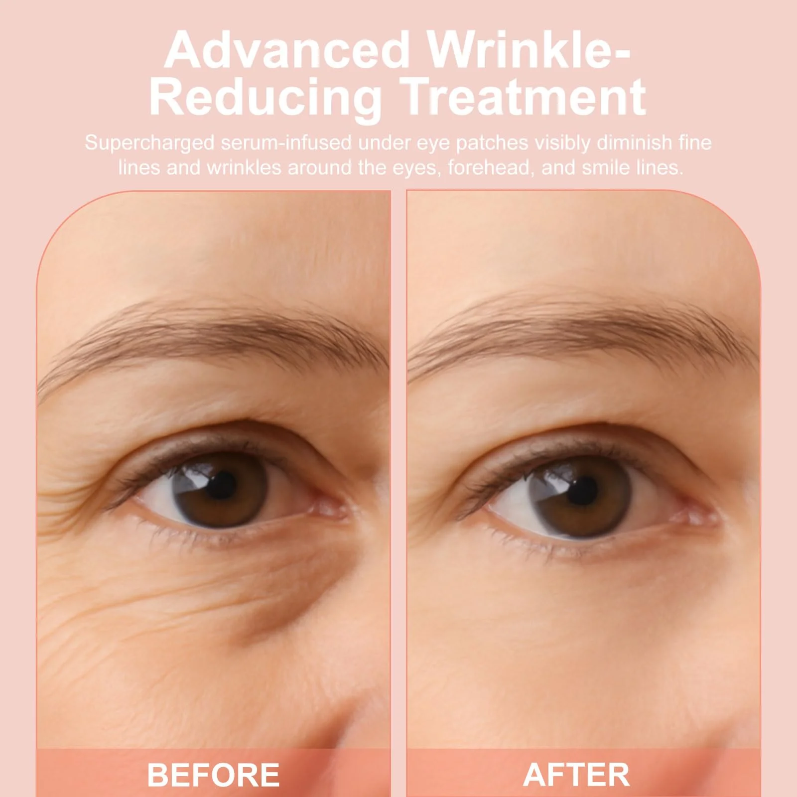 YLOTRE Novalift Micro Eye Patches, Under Eye Patches for Puffy Eyes, Dark Circles & Fine Lines, Deeply Hydrating Anti-Wrinkle Patches, Smooth Application Forehead & Smile Line Patches (2) - Image 3